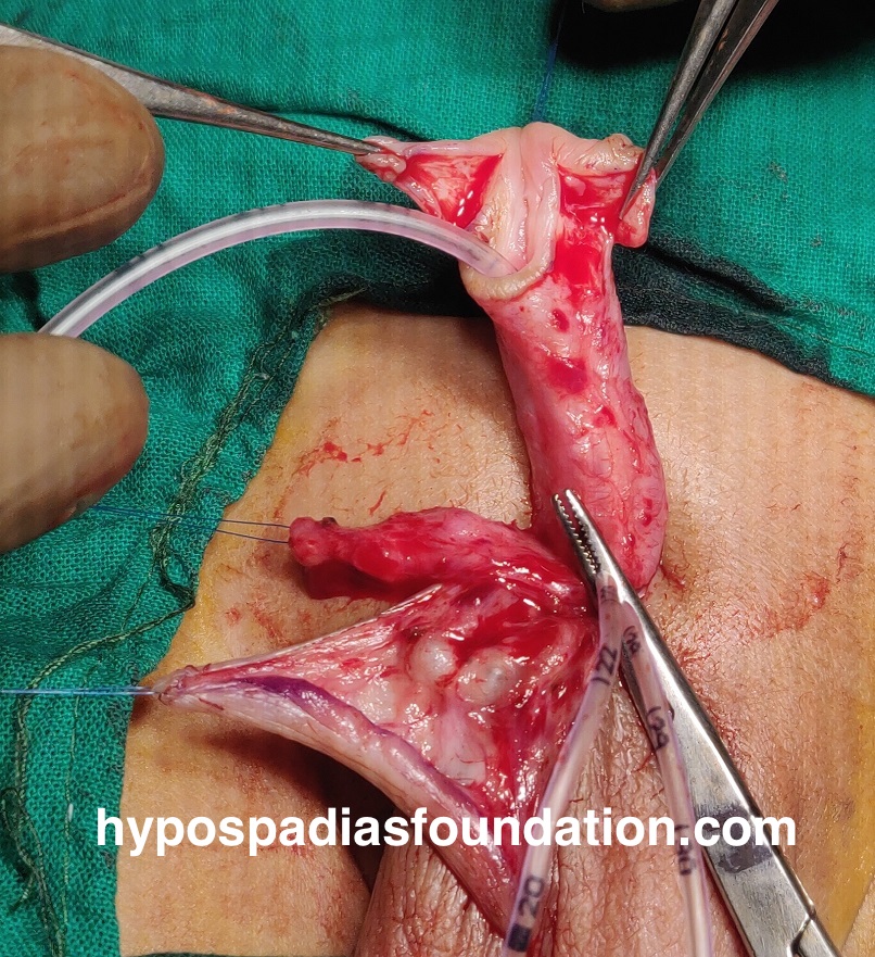 Oral mucosa graft urethroplasty surgery for hypospadias is reserved for cases where multiple surgeries have failed and there is no normal hairless skin left for urethral repair. In expert hands, staged buccal graft surgery repair has excellent results and outcomes with minimal complications. While sometimes the graft can be done in a single stage, especially if the length is very short, in most cases, a staged repair is necessary due to significant scarring and unhealthy tissues. It is preferable to remove all unhealthy tissues and then use healthy mucosa from the mouth, allowing it to heal for six months before performing the urethroplasty. Dr A.K.Singal at Hypospadias Foundation, Navi Mumbai, India, is an expert hypospadias surgeon who achieves successful outcomes in complex hypospadias repairs with fewer complications.