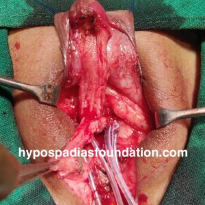 8 (2) female gender assignment surgery