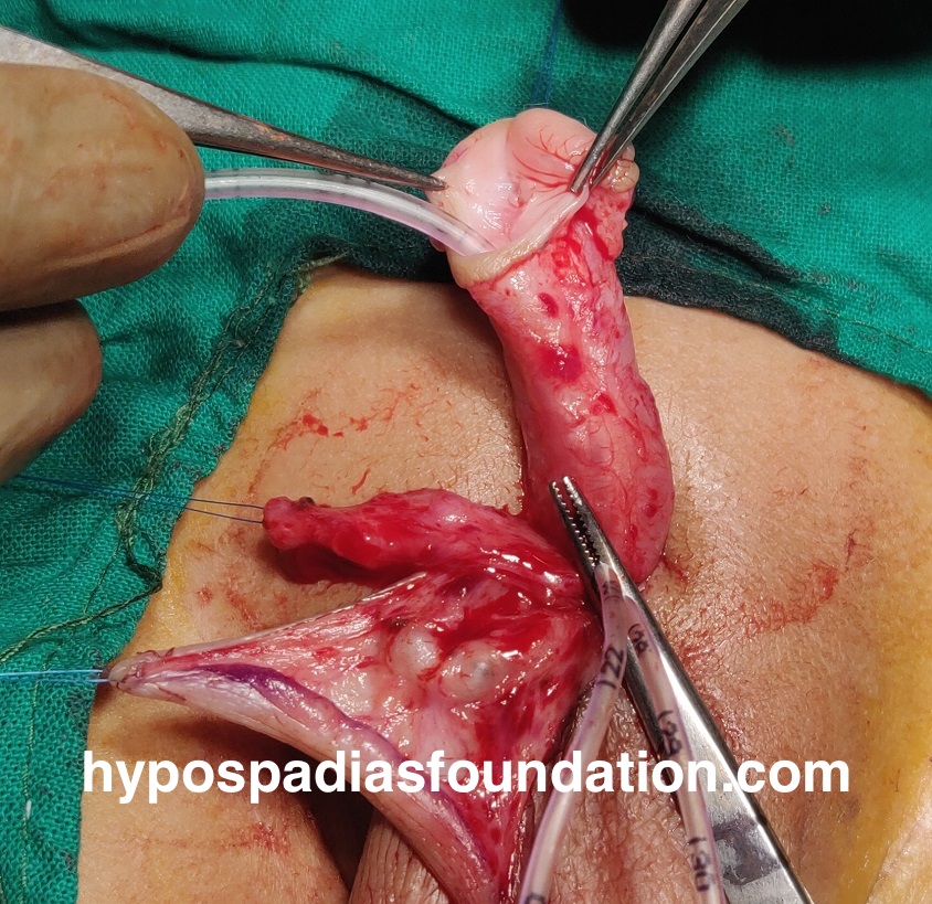 Oral mucosa graft urethroplasty surgery for hypospadias is reserved for cases where multiple surgeries have failed and there is no normal hairless skin left for urethral repair. In expert hands, staged buccal graft surgery repair has excellent results and outcomes with minimal complications. While sometimes the graft can be done in a single stage, especially if the length is very short, in most cases, a staged repair is necessary due to significant scarring and unhealthy tissues. It is preferable to remove all unhealthy tissues and then use healthy mucosa from the mouth, allowing it to heal for six months before performing the urethroplasty. Dr A.K.Singal at Hypospadias Foundation, Navi Mumbai, India, is an expert hypospadias surgeon who achieves successful outcomes in complex hypospadias repairs with fewer complications.