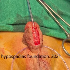 Staged Repair in Proximal Penile Hypospadias