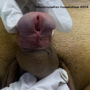 Single stage hypospadias repair in an adult