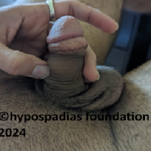 Single stage hypospadias repair in an adult