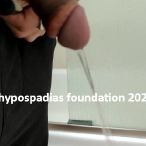 Single stage hypospadias repair in an adult