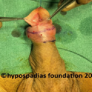 Single stage hypospadias repair in an adult