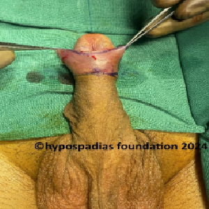 Single stage hypospadias repair in an adult