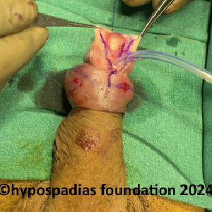 Single stage hypospadias repair in an adult