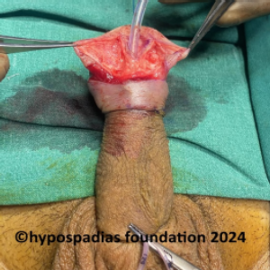 Single stage hypospadias repair in an adult