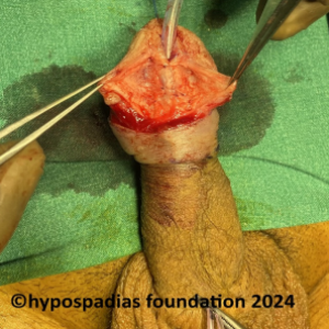 Single stage hypospadias repair in an adult