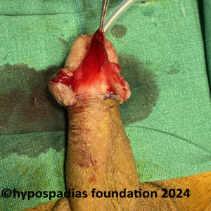 Single stage hypospadias repair in an adult