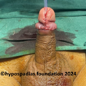 Single stage hypospadias repair in an adult
