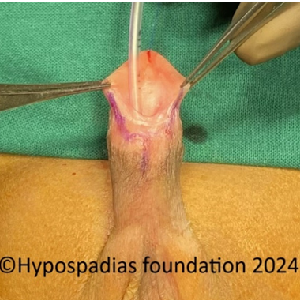 New Project (1) Single stage hypospadias repair in a child
