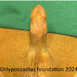 New Project Single stage hypospadias repair in a child