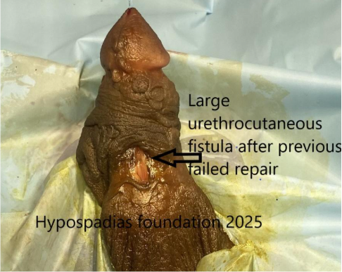 What is urethrocutaneous fistula after hypospadias urethral fistula repair