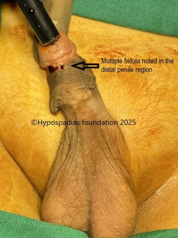 fistula2 fistula2